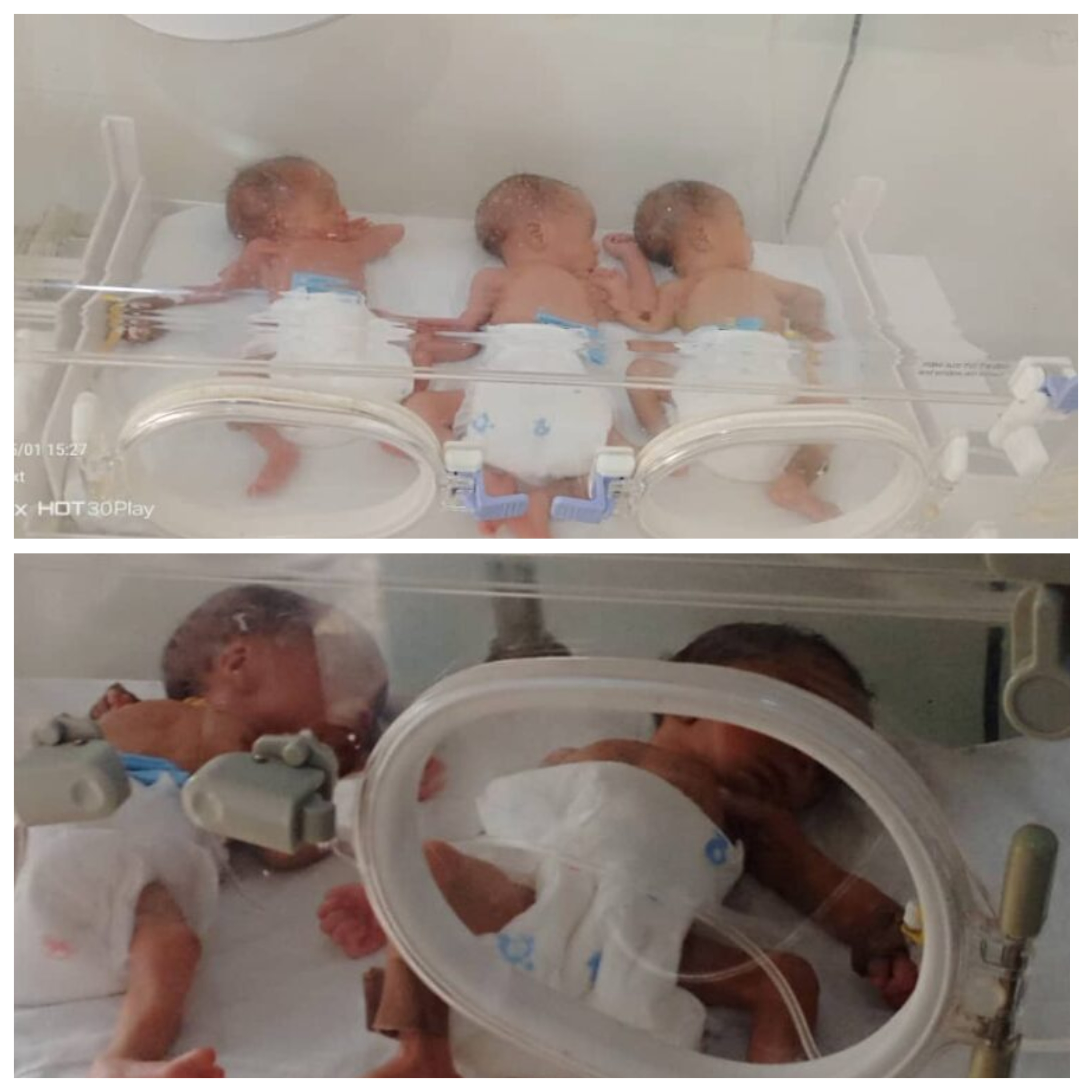 Nigerian woman who was childless for 14 years d!es hours after delivering quintuplets