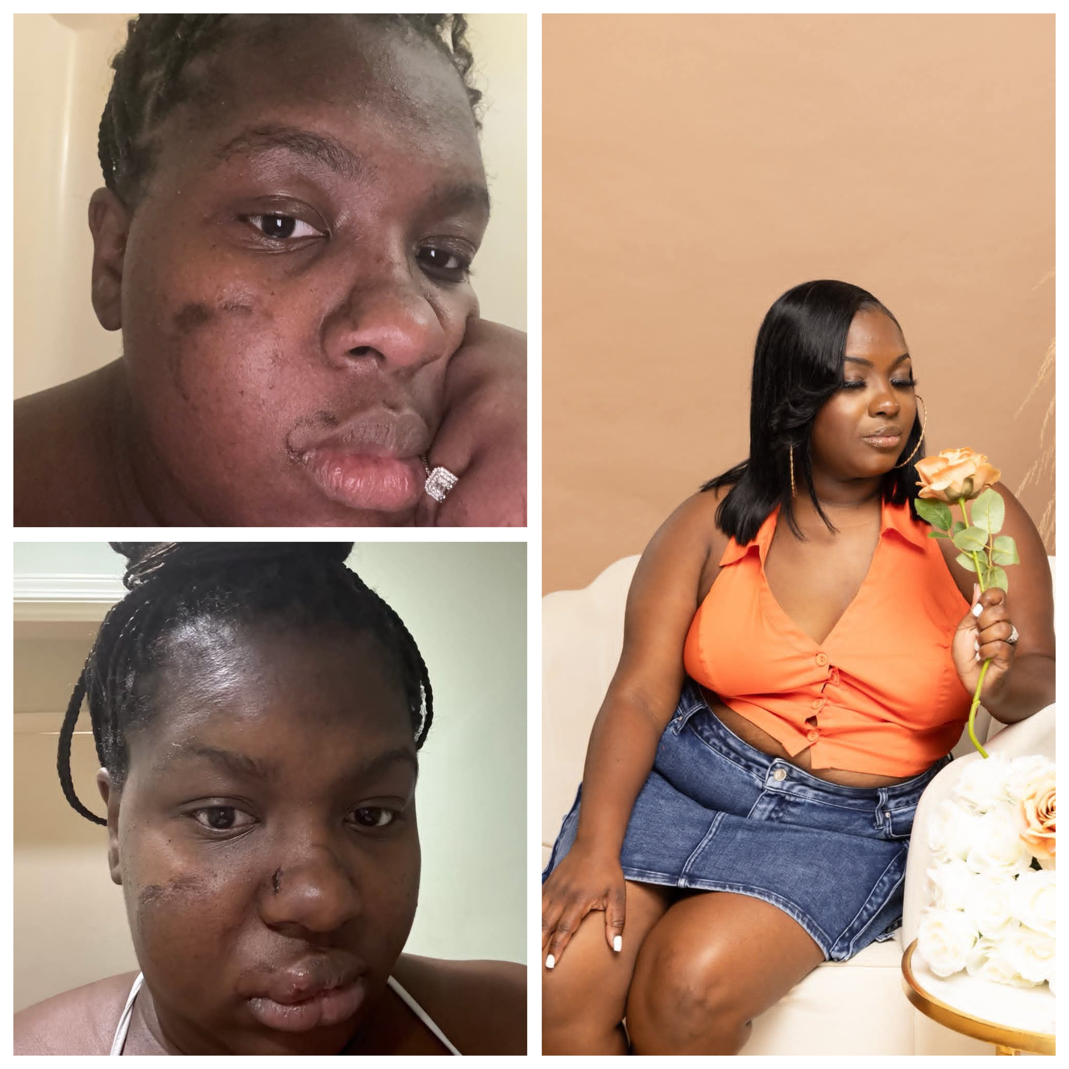 I was attacked and bitten all over my face by my husband when I came home after C-section - Woman shares her experience with domestic violence