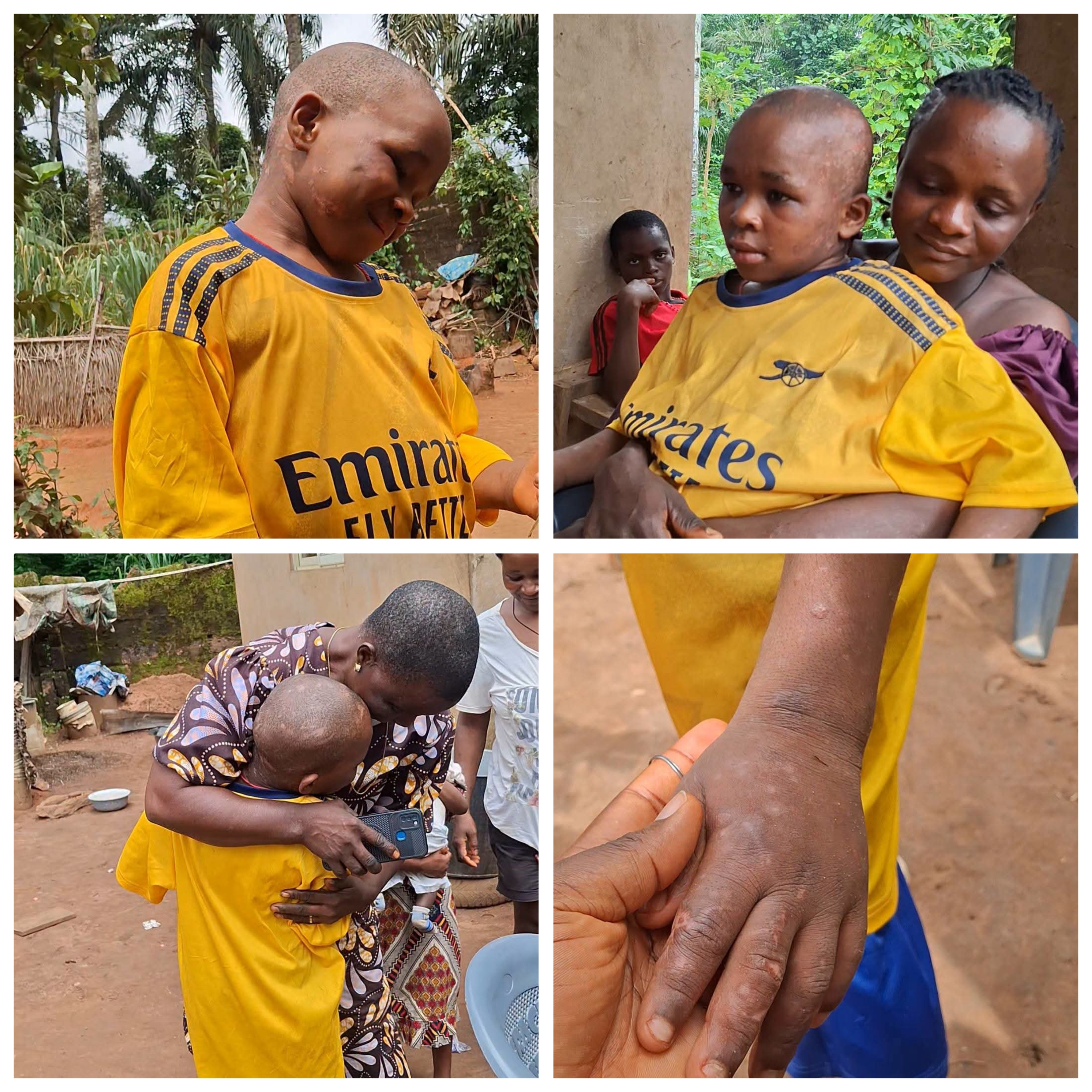 10-year-old boy abused by guardians discharged from hospital in Anambra